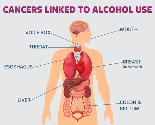 Cancers associated with alcohol include mouth, voice box, throat, esophageal, breast (in women), liver, and colon and rectum
